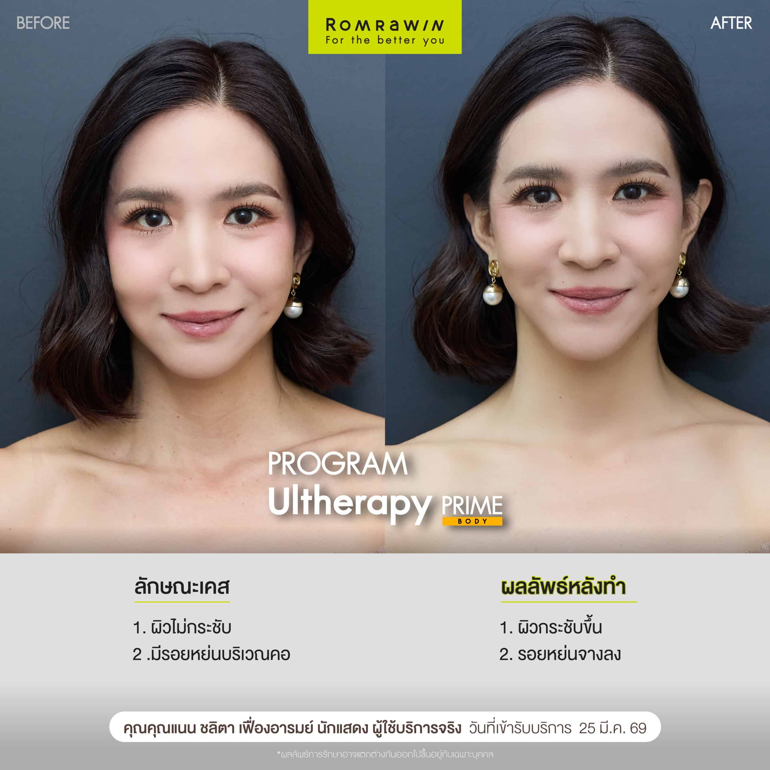 ผลลัพธ์ขึ้นอยู่กับแต่ละบุคคล