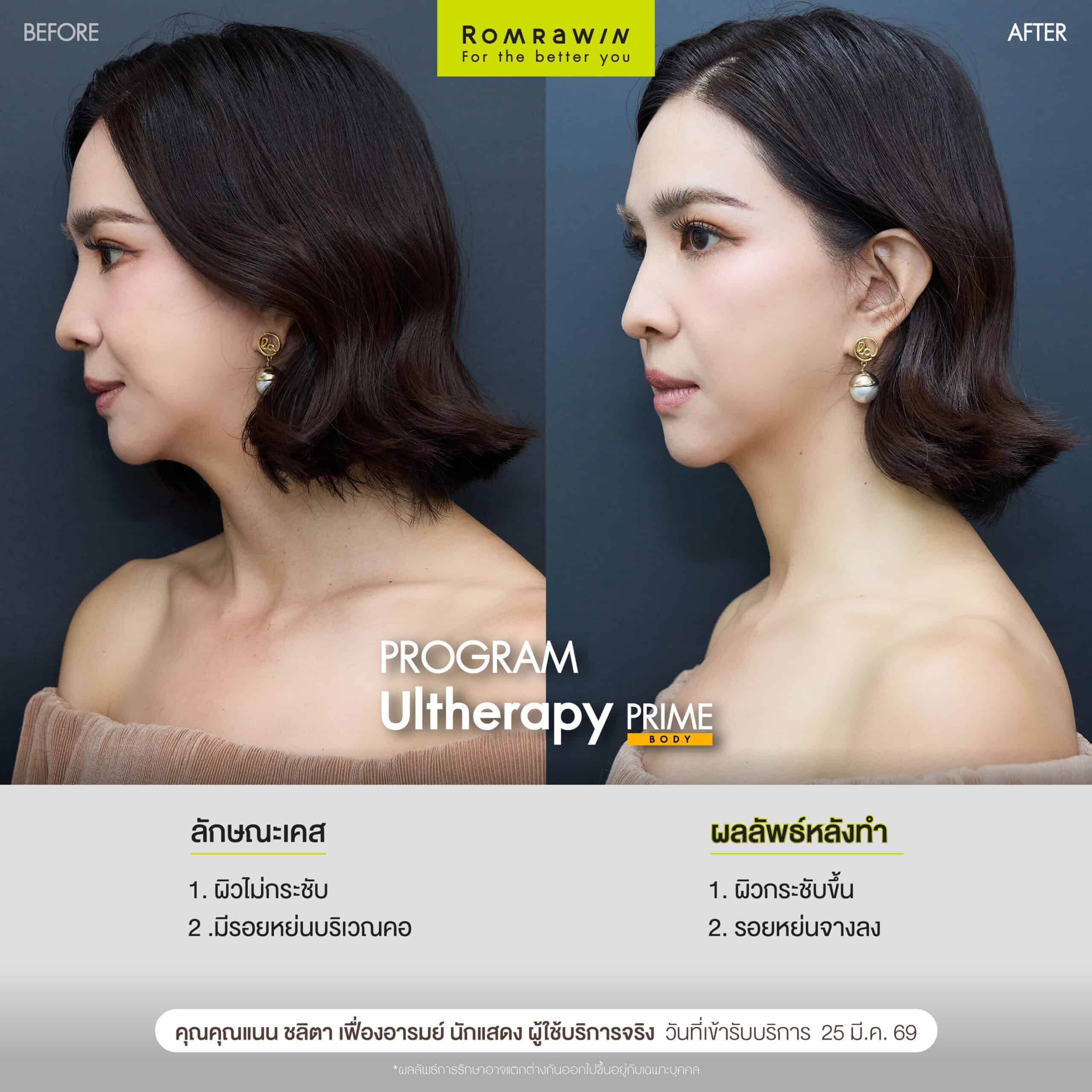 ผลลัพธ์ขึ้นอยู่กับแต่ละบุคคล