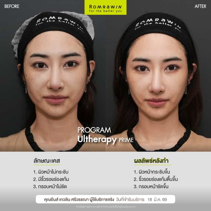 ผลลัพธ์ขึ้นอยู่กับแต่ละบุคคล