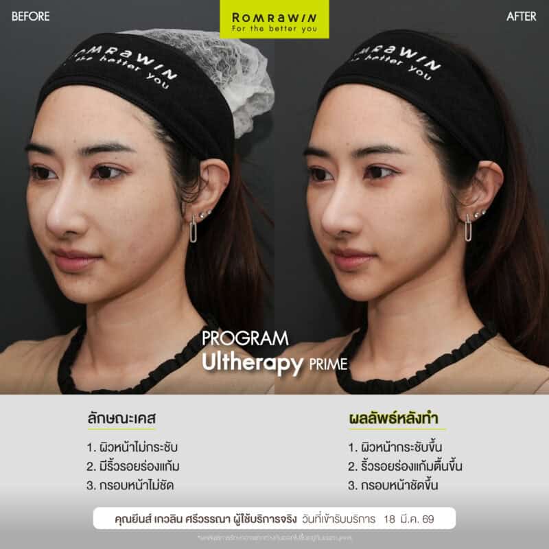 ผลลัพธ์ขึ้นอยู่กับแต่ละบุคคล