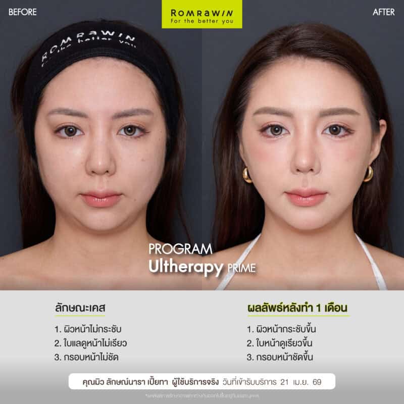 ผลลัพธ์ขึ้นอยู่กับแต่ละบุคคล