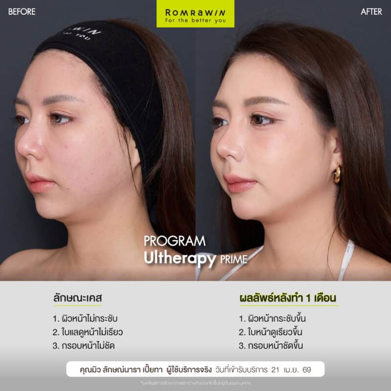 ผลลัพธ์ขึ้นอยู่กับแต่ละบุคคล