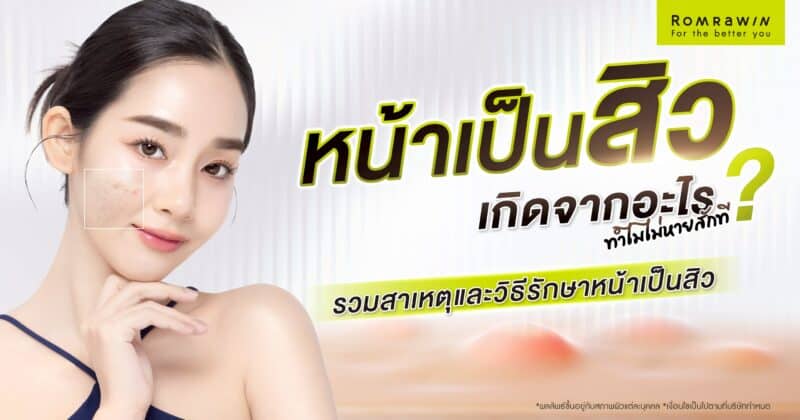 หน้าเป็นสิว