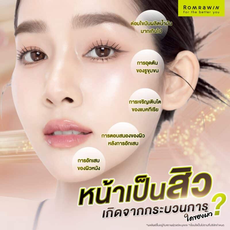 หน้าเป็นสิวเกิดจากกระบวนการใดของผิว