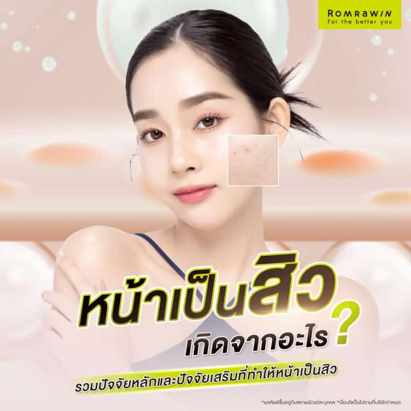 หน้าเป็นสิวเกิดจากอะไร? 