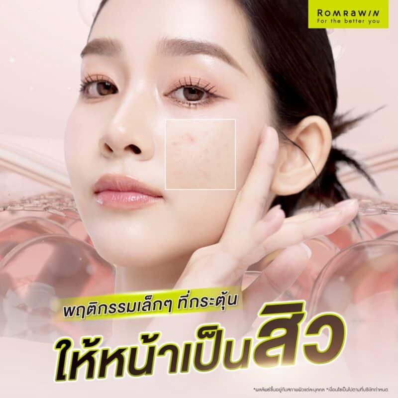 พฤติกรรมเล็กๆ ที่กระตุ้นให้หน้าเป็นสิวได้