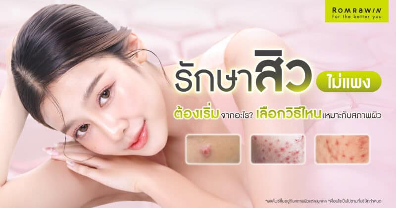 รักษาสิวไม่แพง