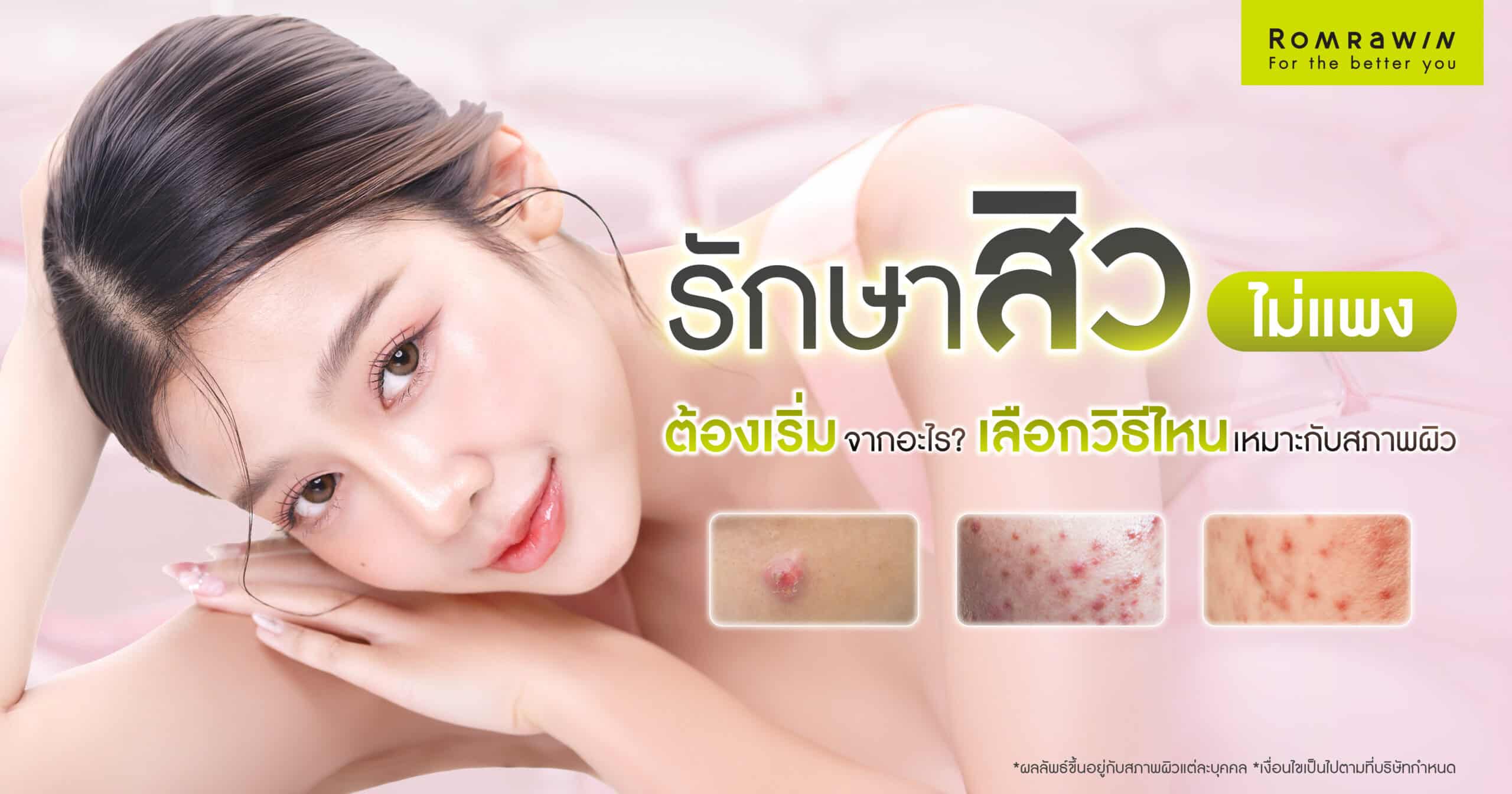 รักษาสิวไม่แพง