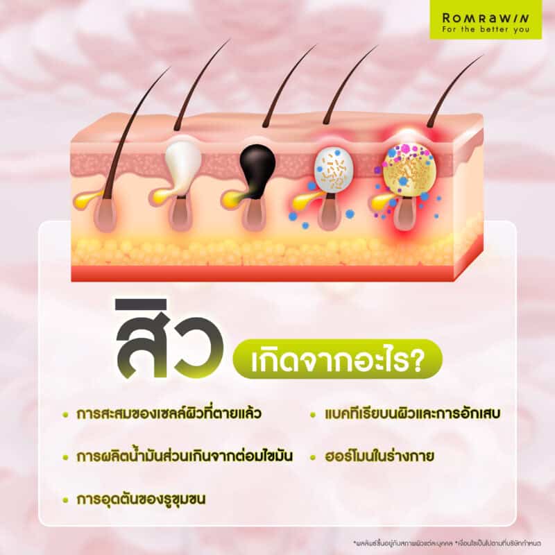 สิวเกิดจากอะไร?