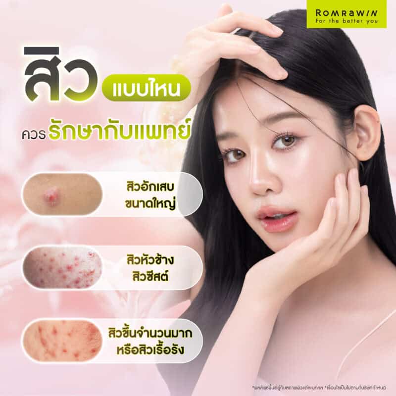 สิวแบบไหนควรรักษากับแพทย์