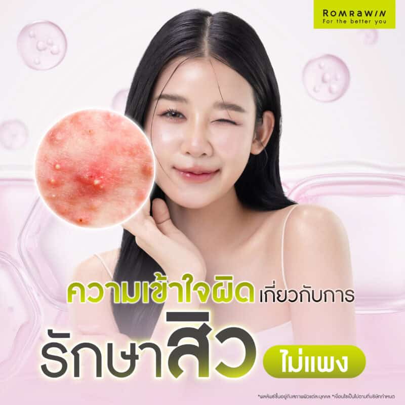 ความเข้าใจผิดเกี่ยวกับการรักษาสิวไม่แพง