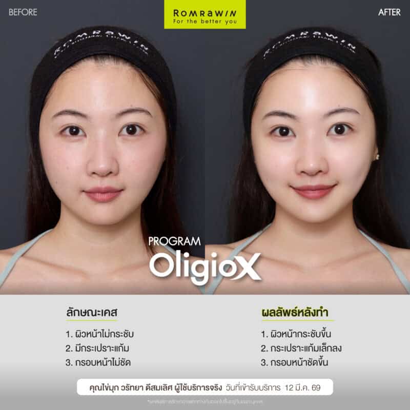 ผลลัพธ์ขึ้นอยู่กับแต่ละบุคคล