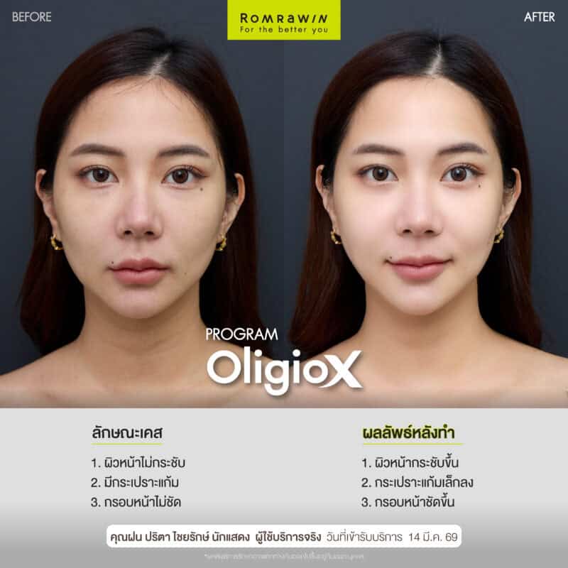 ผลลัพธ์ขึ้นอยู่กับแต่ละบุคคล