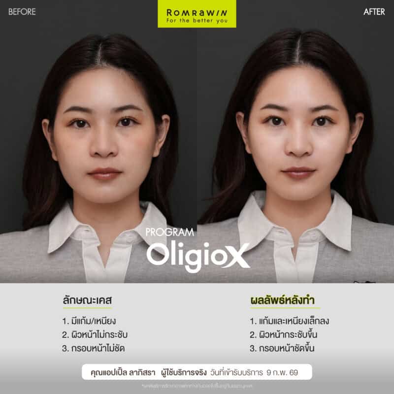 ผลลัพธ์ขึ้นอยู่กับแต่ละบุคคล