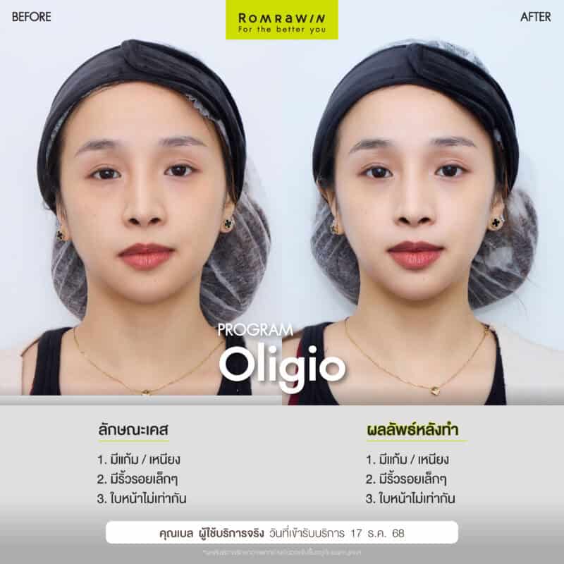 ผลลัพธ์ขึ้นอยู่กับแต่ละบุคคล