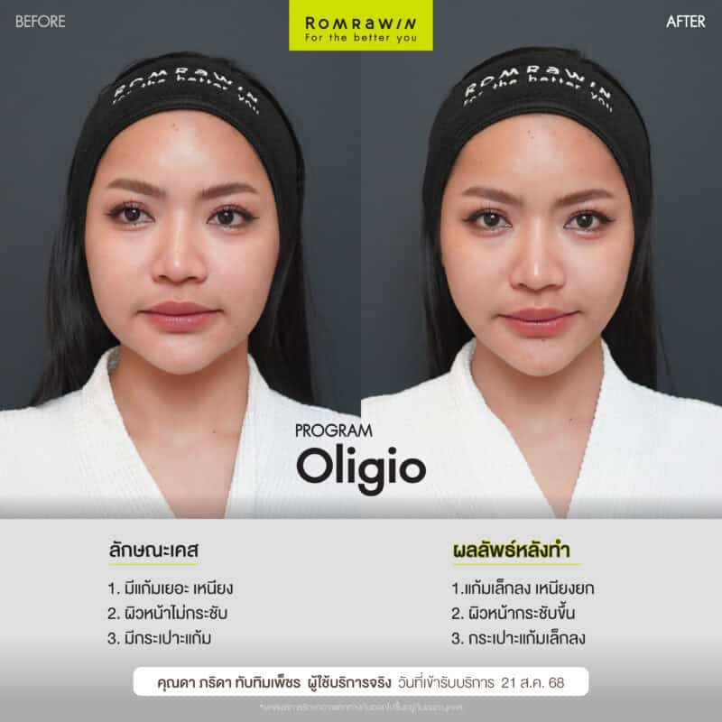 ผลลัพธ์ขึ้นอยู่กับแต่ละบุคคล