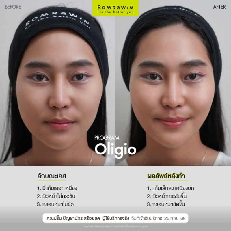 ผลลัพธ์ขึ้นอยู่กับแต่ละบุคคล