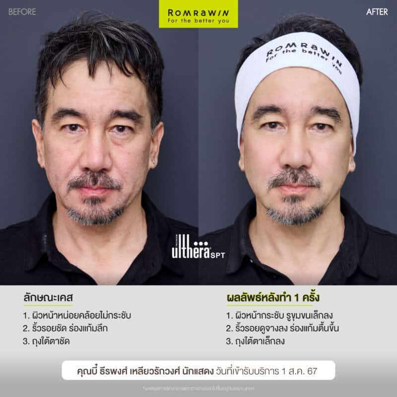 ผลลัพธ์ขึ้นอยู่กับแต่ละบุคคล
