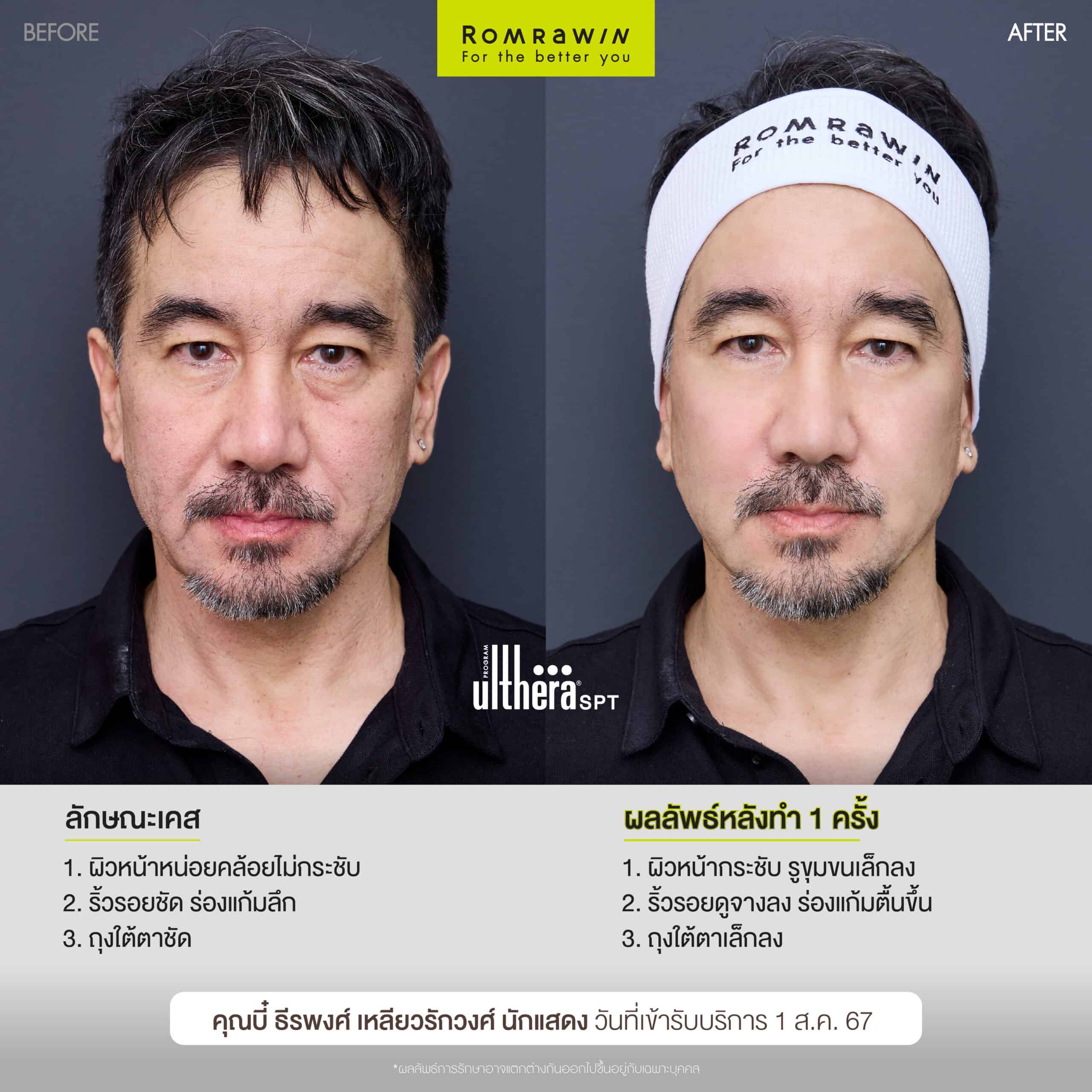 ผลลัพธ์ขึ้นอยู่กับแต่ละบุคคล