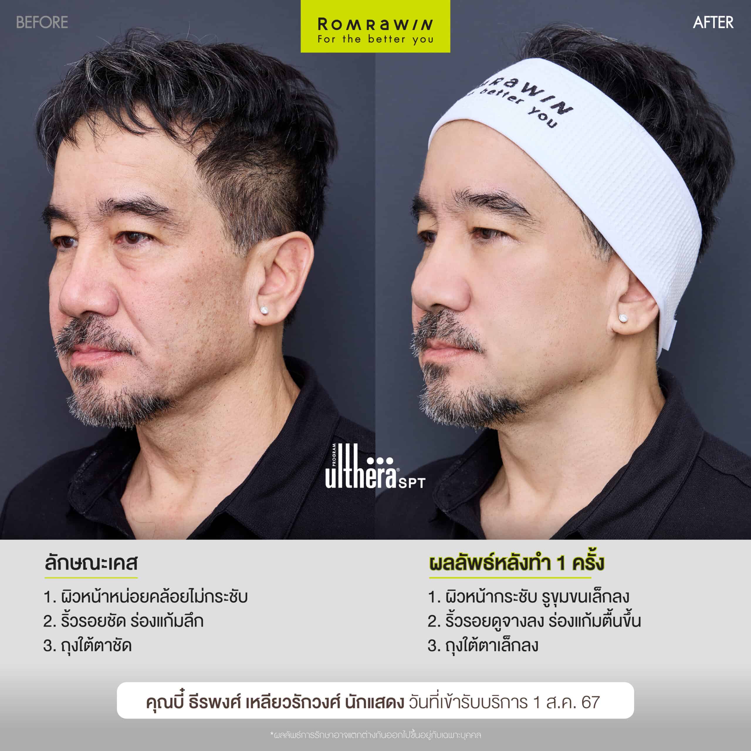 ผลลัพธ์ขึ้นอยู่กับแต่ละบุคคล