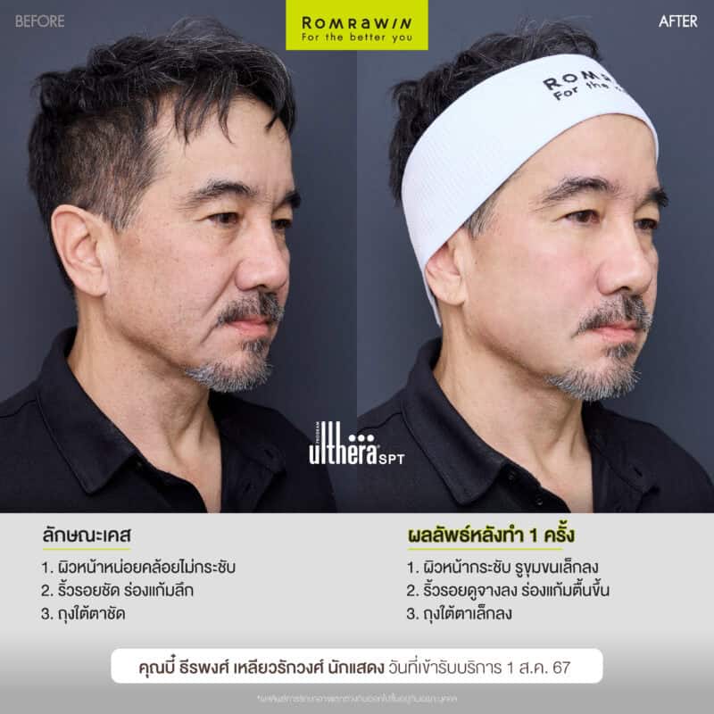 ผลลัพธ์ขึ้นอยู่กับแต่ละบุคคล