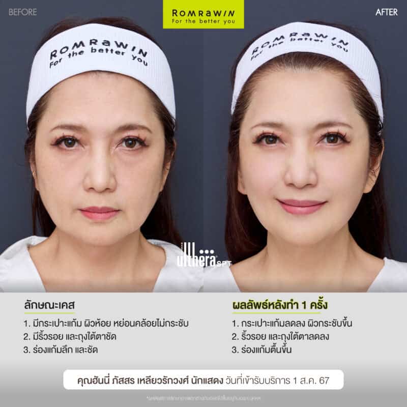 ผลลัพธ์ขึ้นอยู่กับแต่ละบุคคล