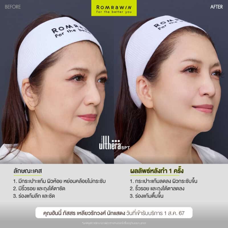 ผลลัพธ์ขึ้นอยู่กับแต่ละบุคคล