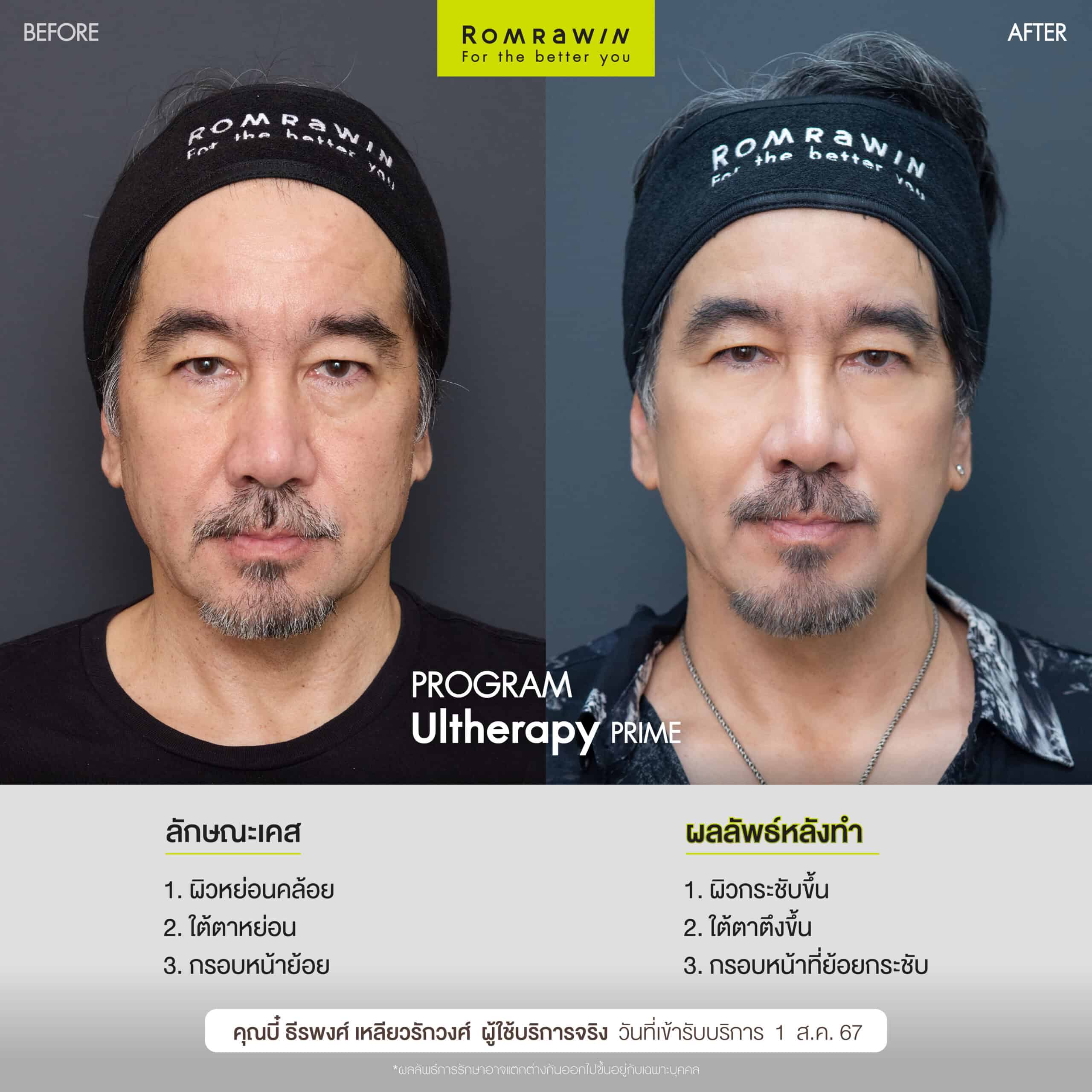 ผลลัพธ์ขึ้นอยู่กับแต่ละบุคคล