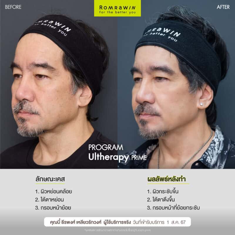 ผลลัพธ์ขึ้นอยู่กับแต่ละบุคคล