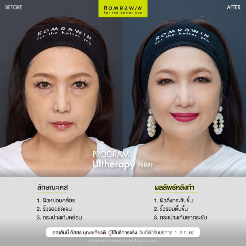 ผลลัพธ์ขึ้นอยู่กับแต่ละบุคคล