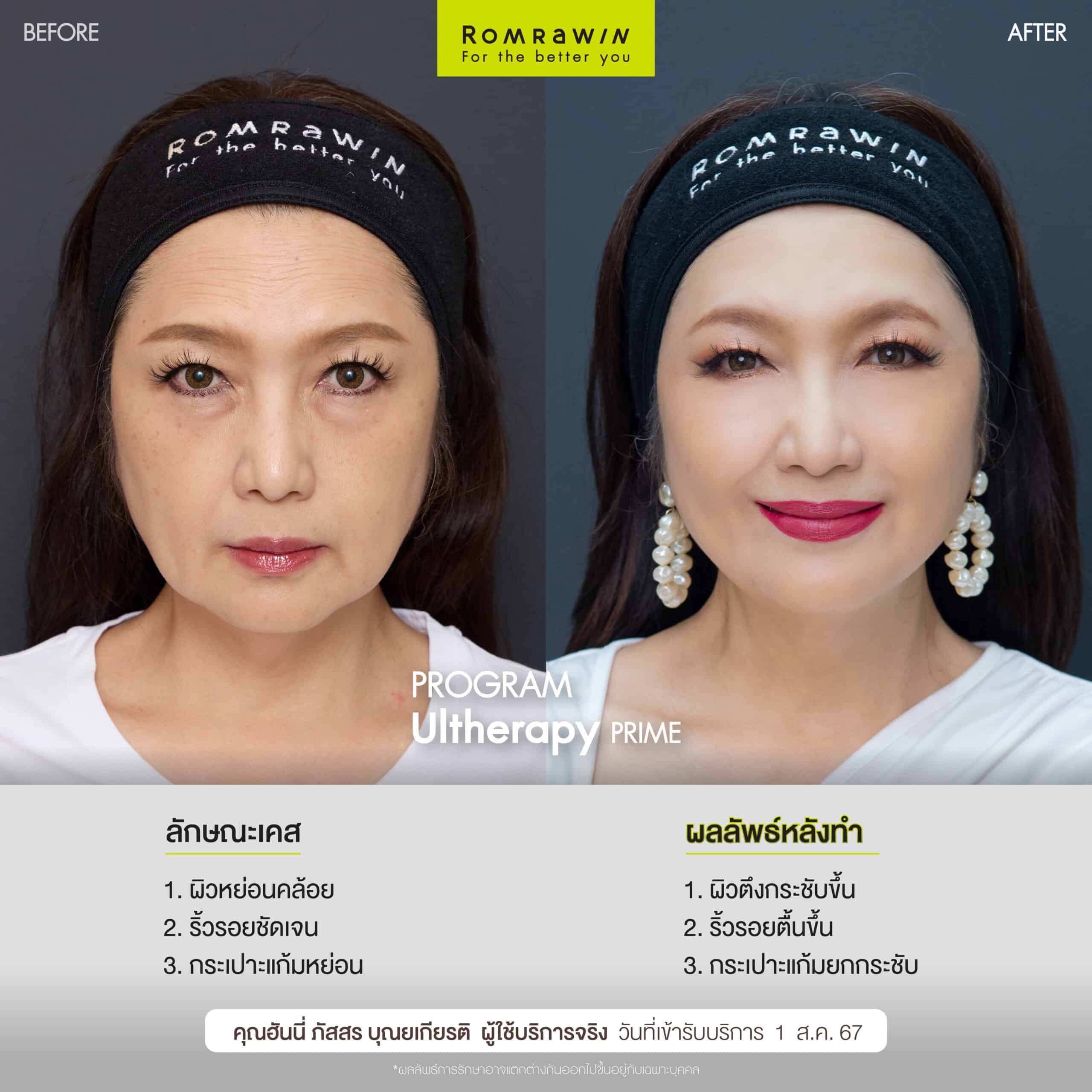 ผลลัพธ์ขึ้นอยู่กับแต่ละบุคคล