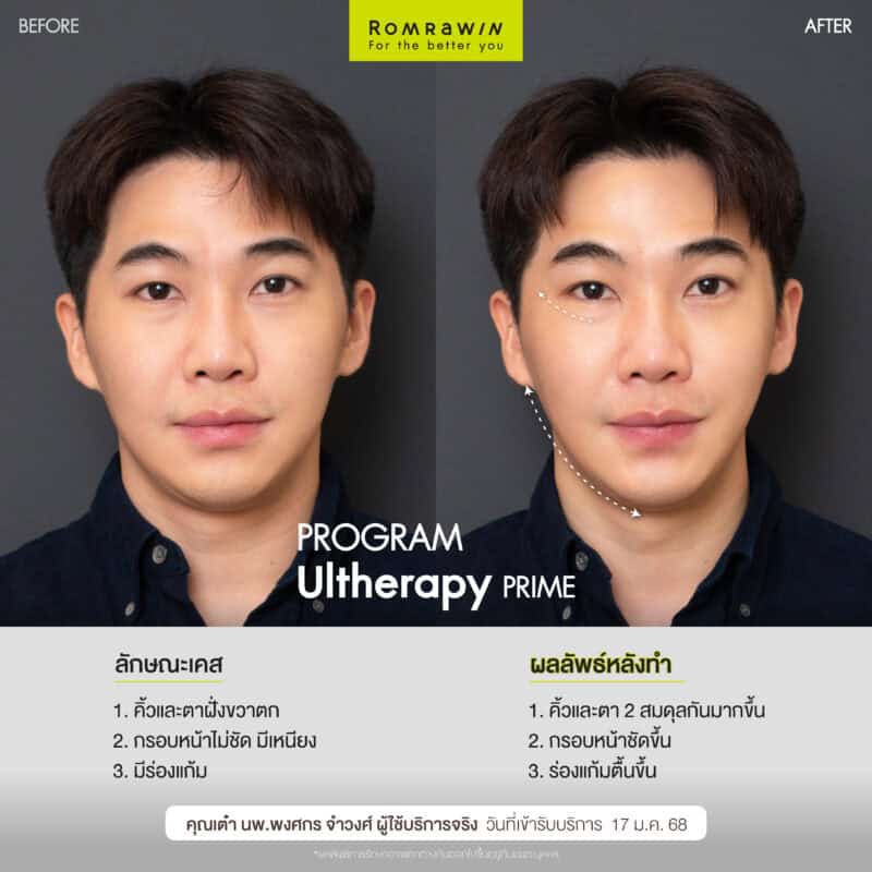 ผลลัพธ์ขึ้นอยู่กับแต่ละบุคคล