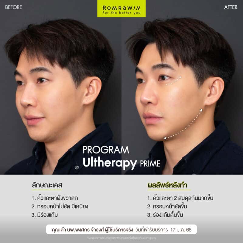 ผลลัพธ์ขึ้นอยู่กับแต่ละบุคคล