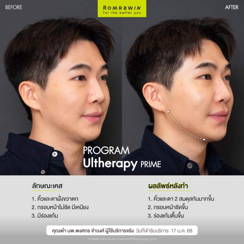 ผลลัพธ์ขึ้นอยู่กับแต่ละบุคคล