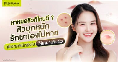 หาหมอสิวที่ไหนดี