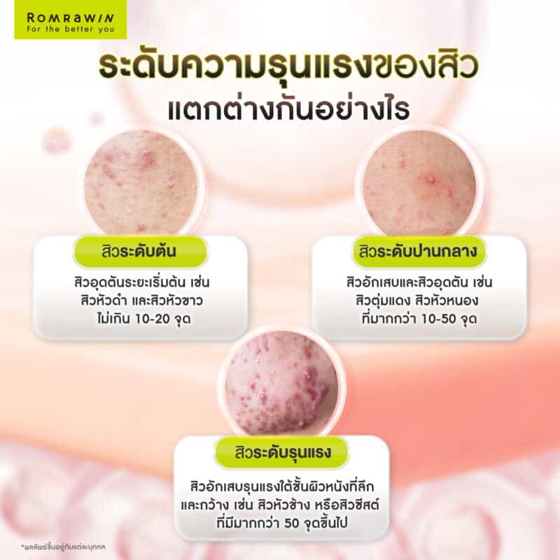 ระดับความรุนแรงของสิว แตกต่างกันอย่างไร