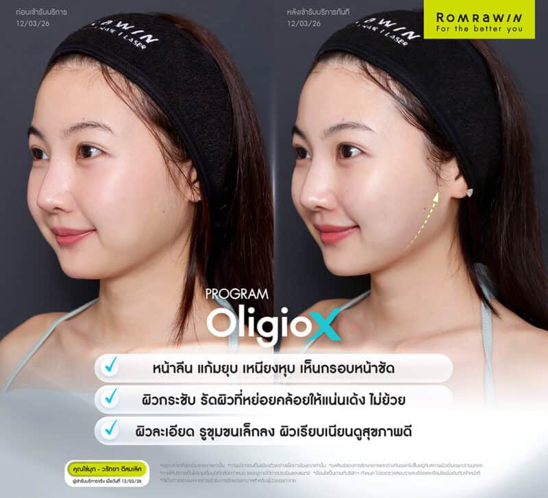 ผลลัพธ์ขึ้นอยู่กับแต่ละบุคคล