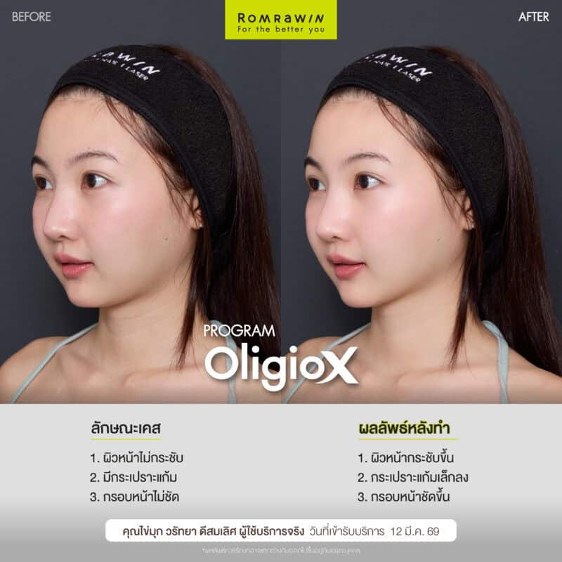 ผลลัพธ์ขึ้นอยู่กับแต่ละบุคคล