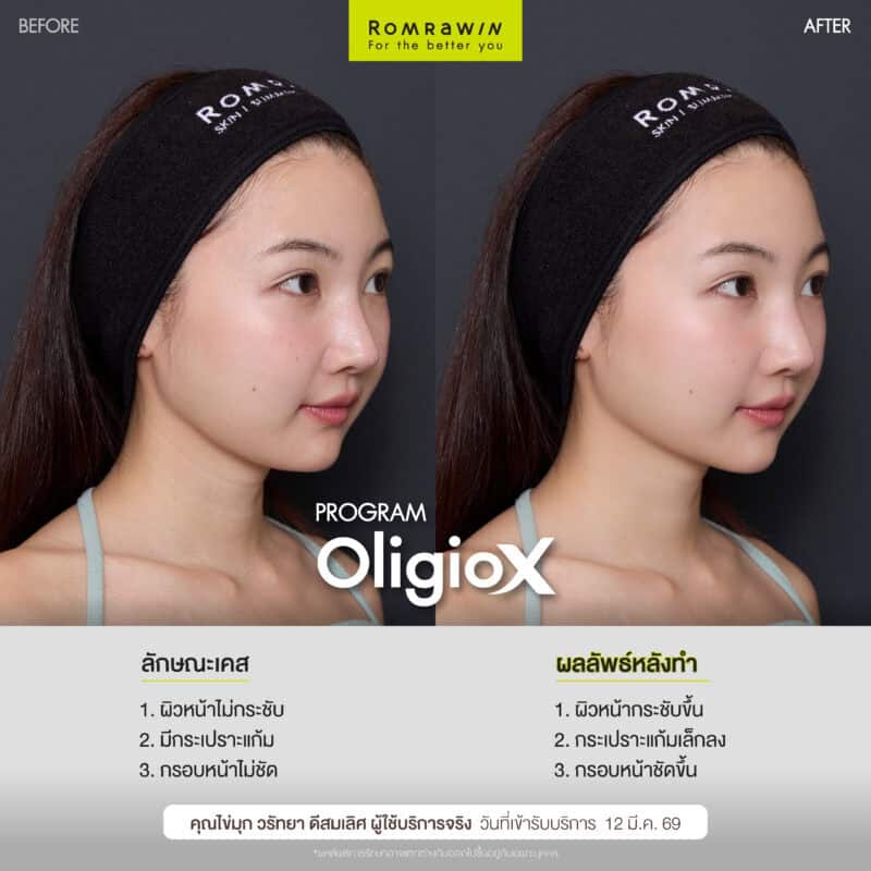 ผลลัพธ์ขึ้นอยู่กับแต่ละบุคคล