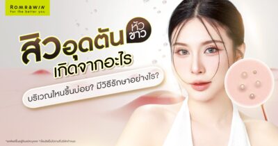 สิวอุดตันหัวขาว