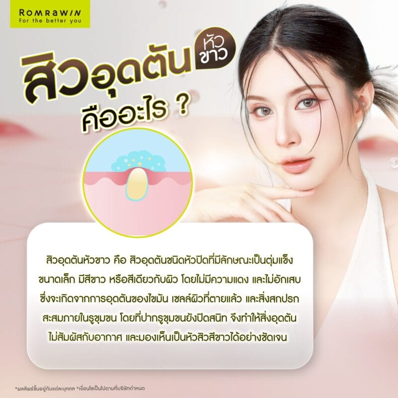 สิวอุดตันหัวขาวคืออะไร?