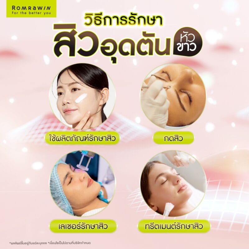 วิธีรักษาสิวอุดตันหัวขาว