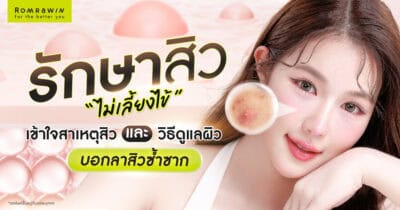 รักษาสิวไม่เลี้ยงไข้