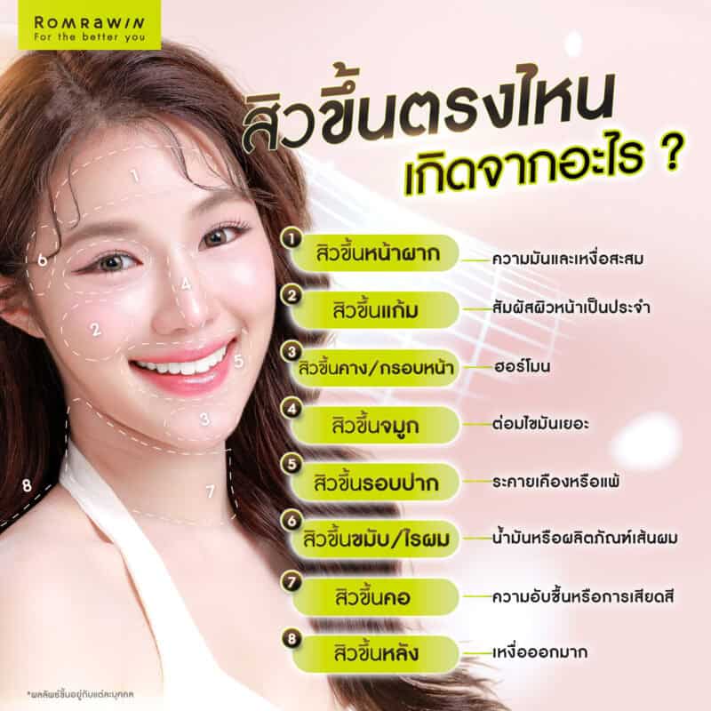 สิวขึ้นตรงไหน เกิดจากอะไร ?