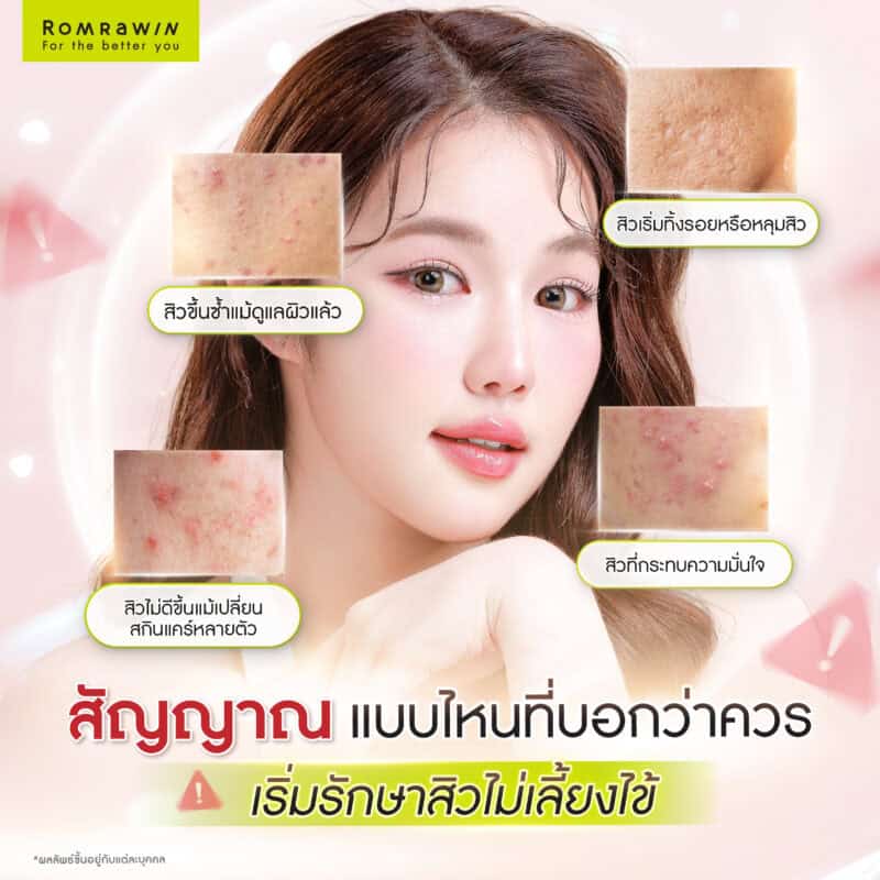 สัญญาณแบบไหนที่บอกว่าควรเริ่มรักษาสิวไม่เลี้ยงไข้