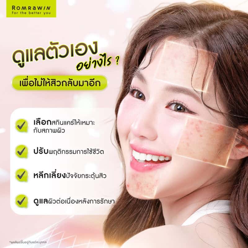 ดูแลตัวเองอย่างไร เพื่อไม่ให้สิวกลับมาอีก