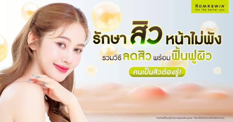 รักษาสิวหน้าไม่พัง