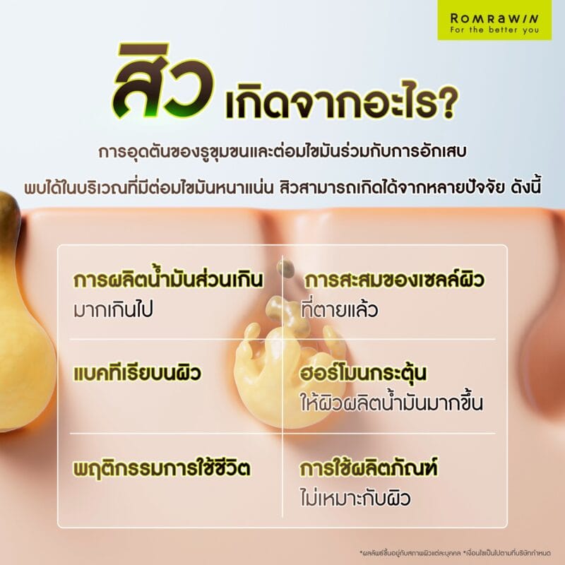 สิวเกิดจากอะไร?