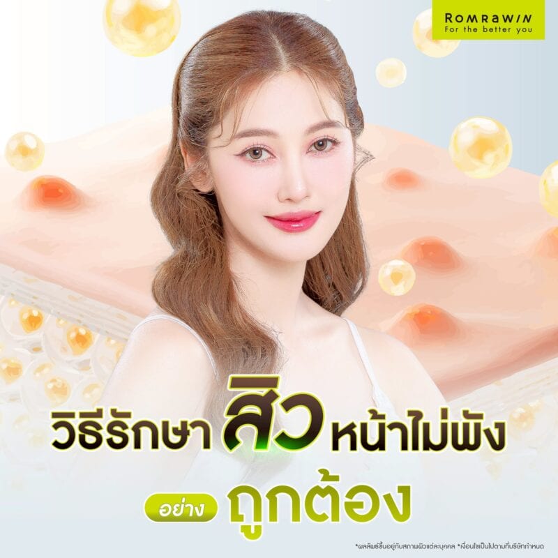 วิธีรักษาสิวหน้าไม่พังอย่างถูกต้อง