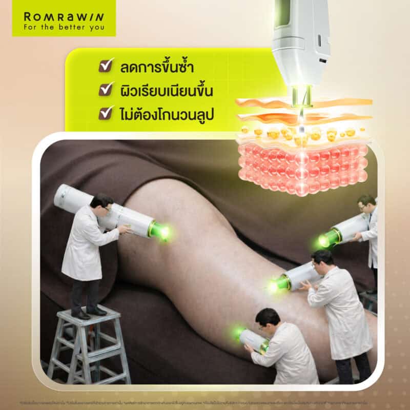 ผลลัพธ์ขึ้นอยู่กับแต่ละบุคคล